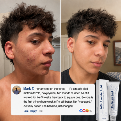 Suverta 14% Azelaic Acid Barrier Cream (Redness Control for Men)
