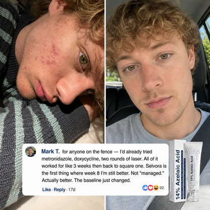 Suverta 14% Azelaic Acid Barrier Cream (Redness Control for Men)