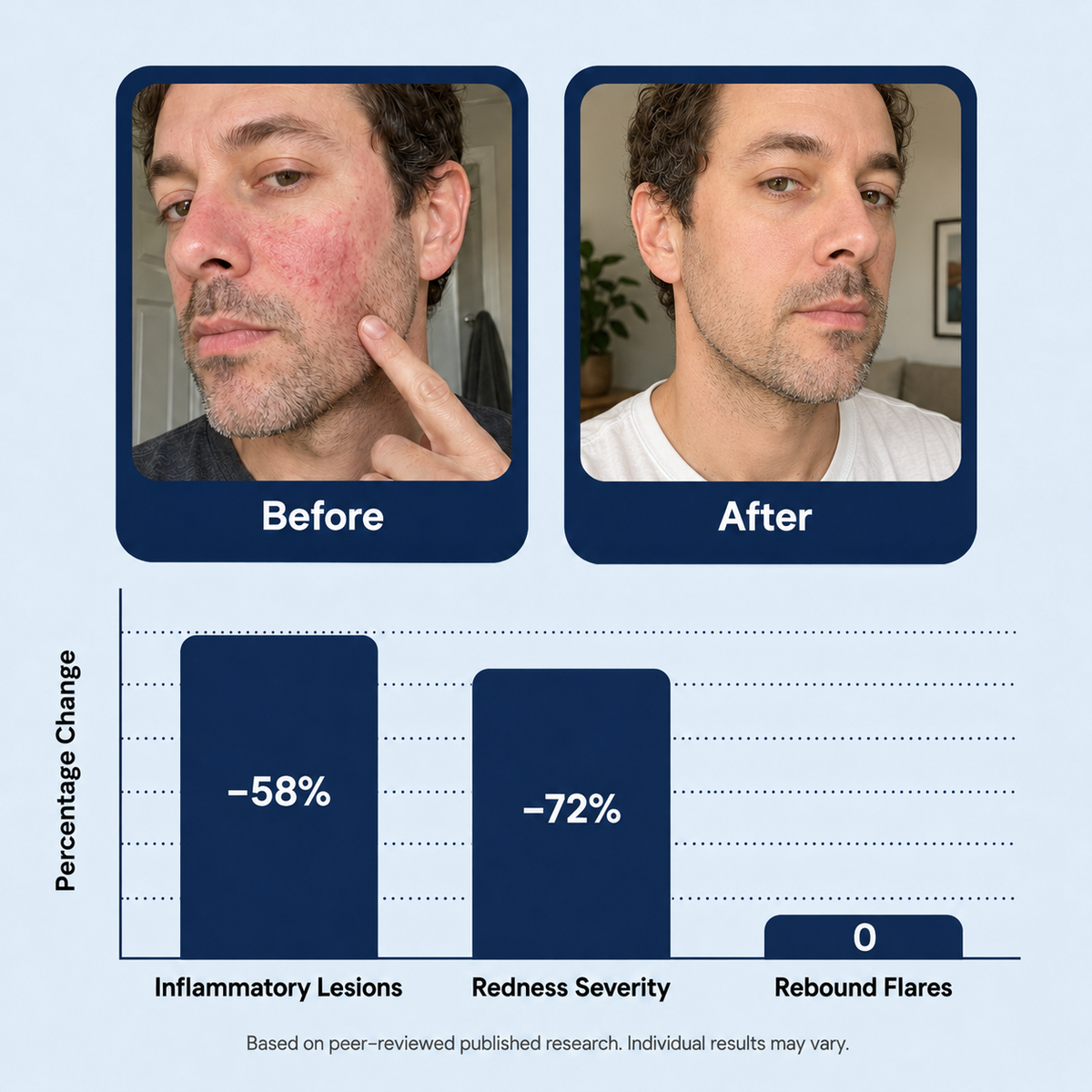Suverta 14% Azelaic Acid Barrier Cream (Redness Control for Men)